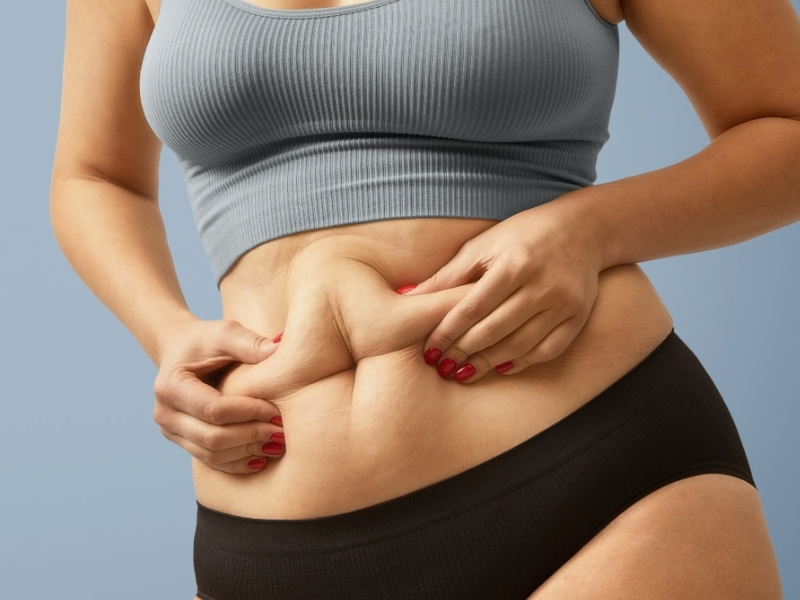 Excesso de pele após bariátrica: quando cirurgia vai além da estética